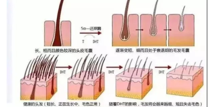 山东新技术养发修复效果,养发